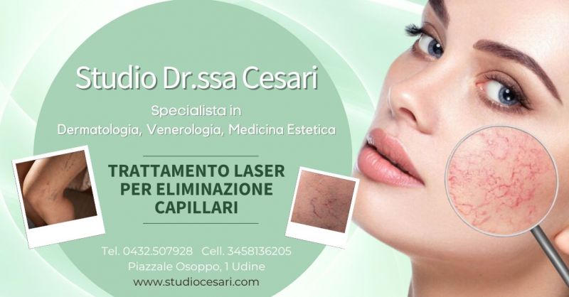 trattamento laser per eliminazione capillari