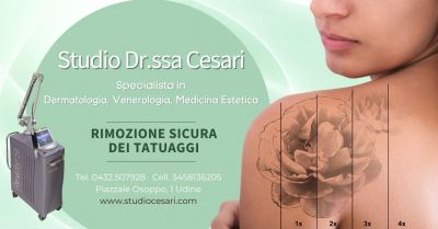 rimozione sicura tatuaggi laser studio specializzato